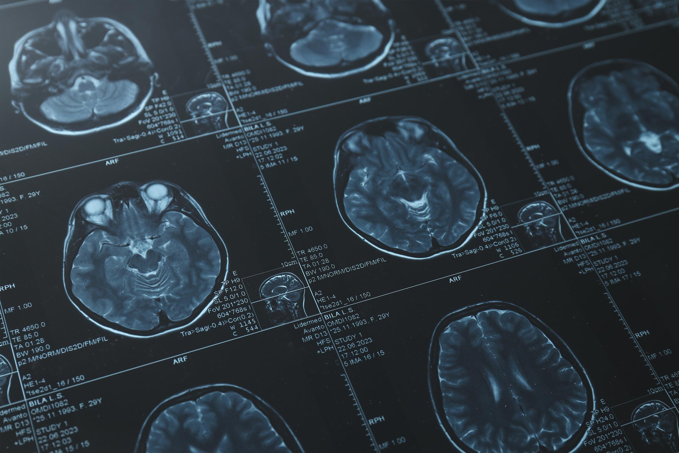 Alzheimer's Screening 